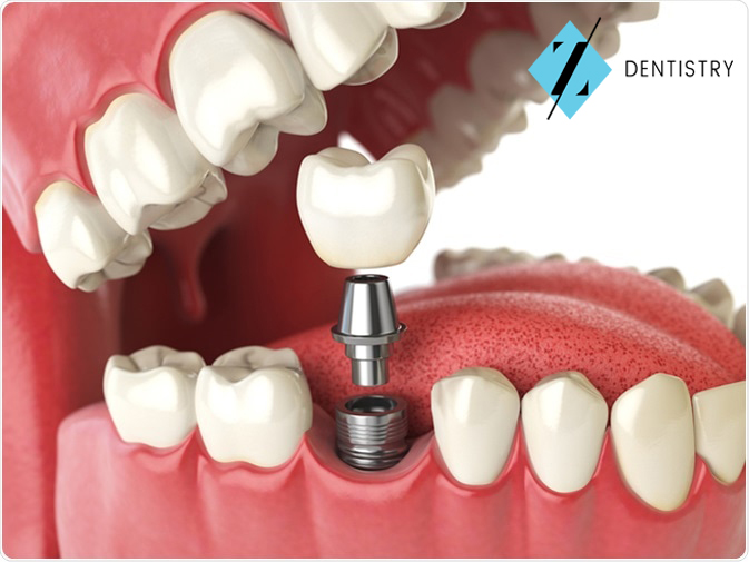 Five Reasons to Get Dental Implants