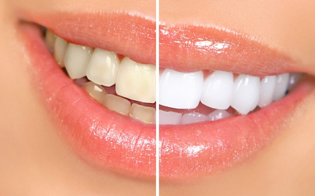 Professional vs. Commercial Teeth Whitening