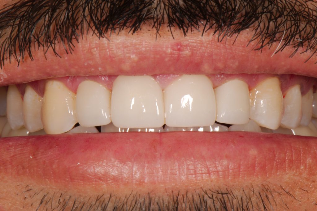 3 Types of Smile Makeovers Z Dentistry