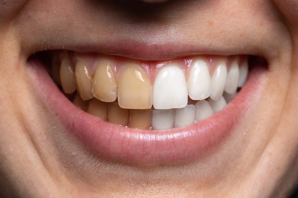 Teeth-Staining: Causes and Prevention