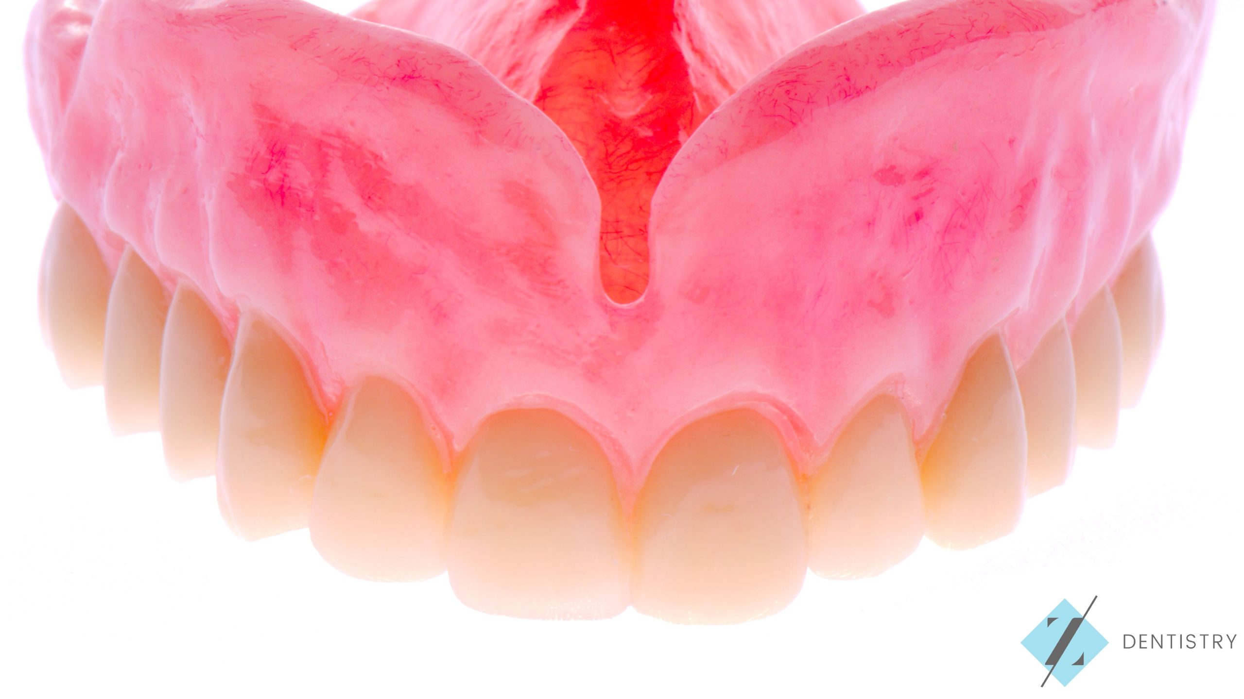 Full Upper removable Dentures, Z Dentistry, Roanoke, TX