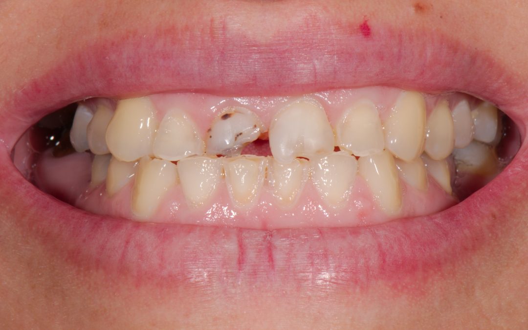Why Do I Have Chipped Teeth?