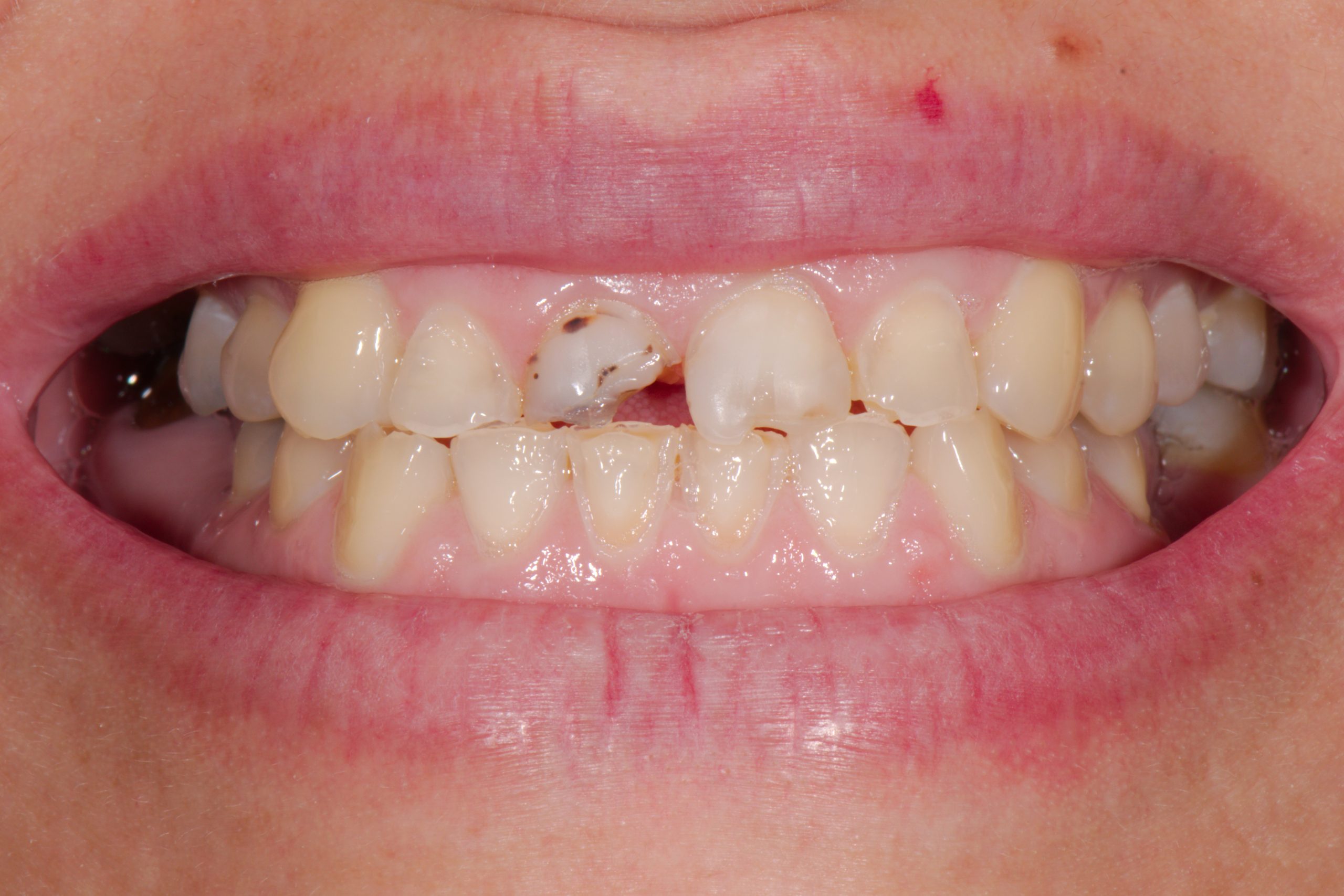 Chipped Teeth, Z Dentistry, Northlake, TX , Roanoke, TX