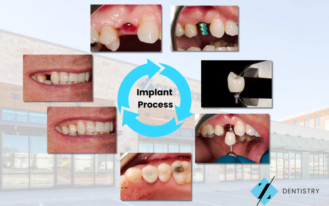 A Complete Guide to Getting Dental Implants: A Journey Towards a Healthy Smile