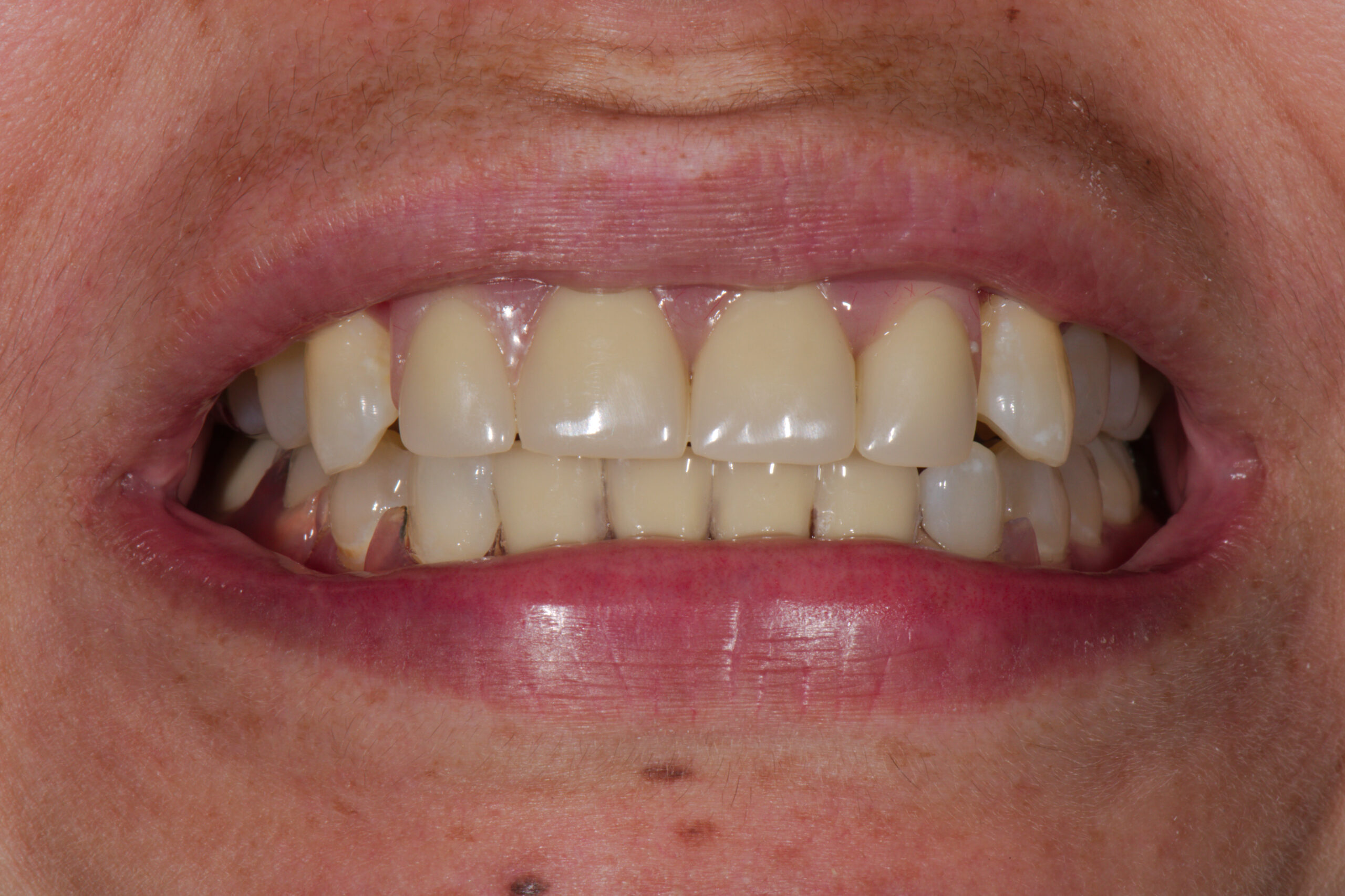 partial denture, Z Dentistry, Roanoke, TX, Dr. Z