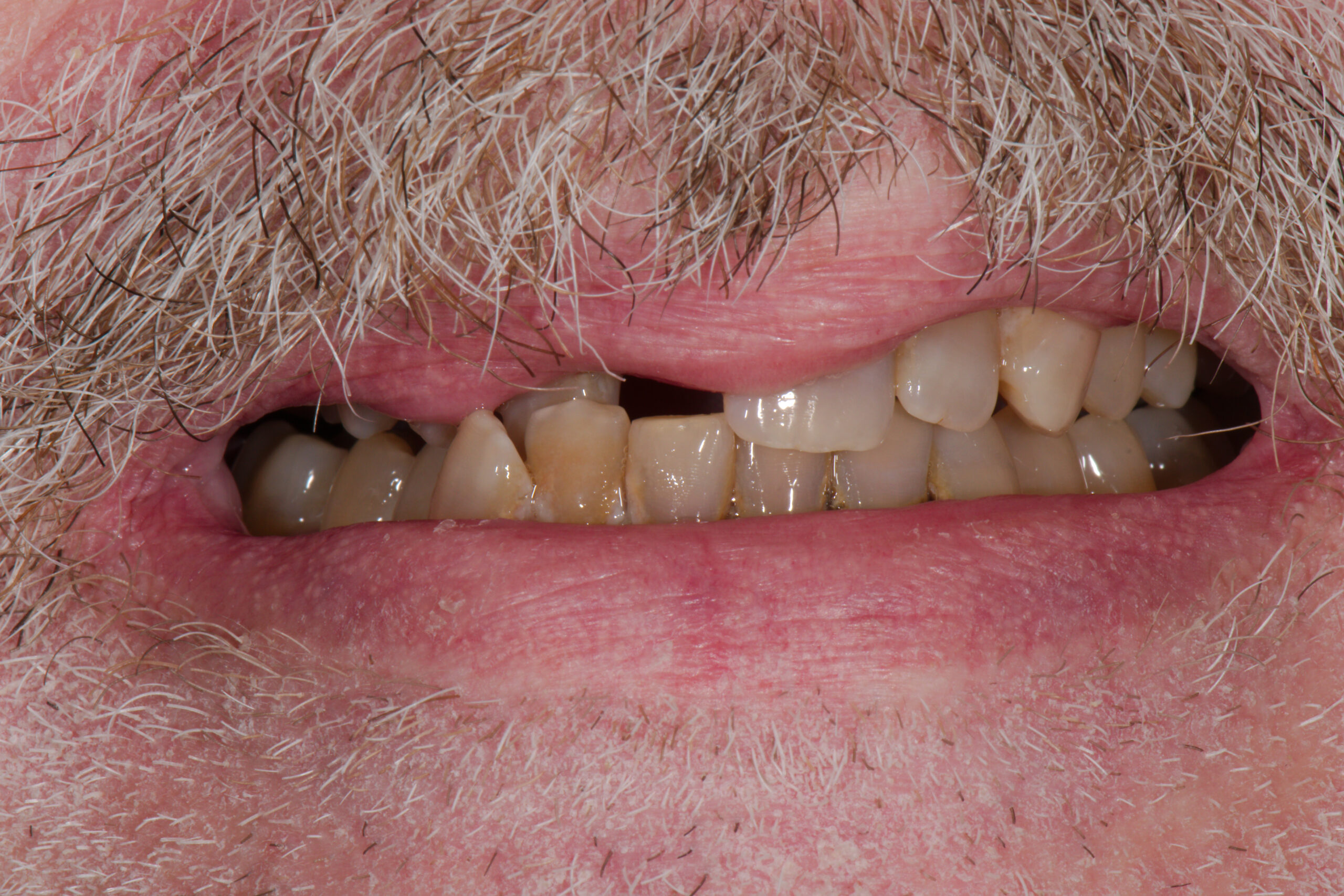 BEFORE: Upper Front Partial Denture