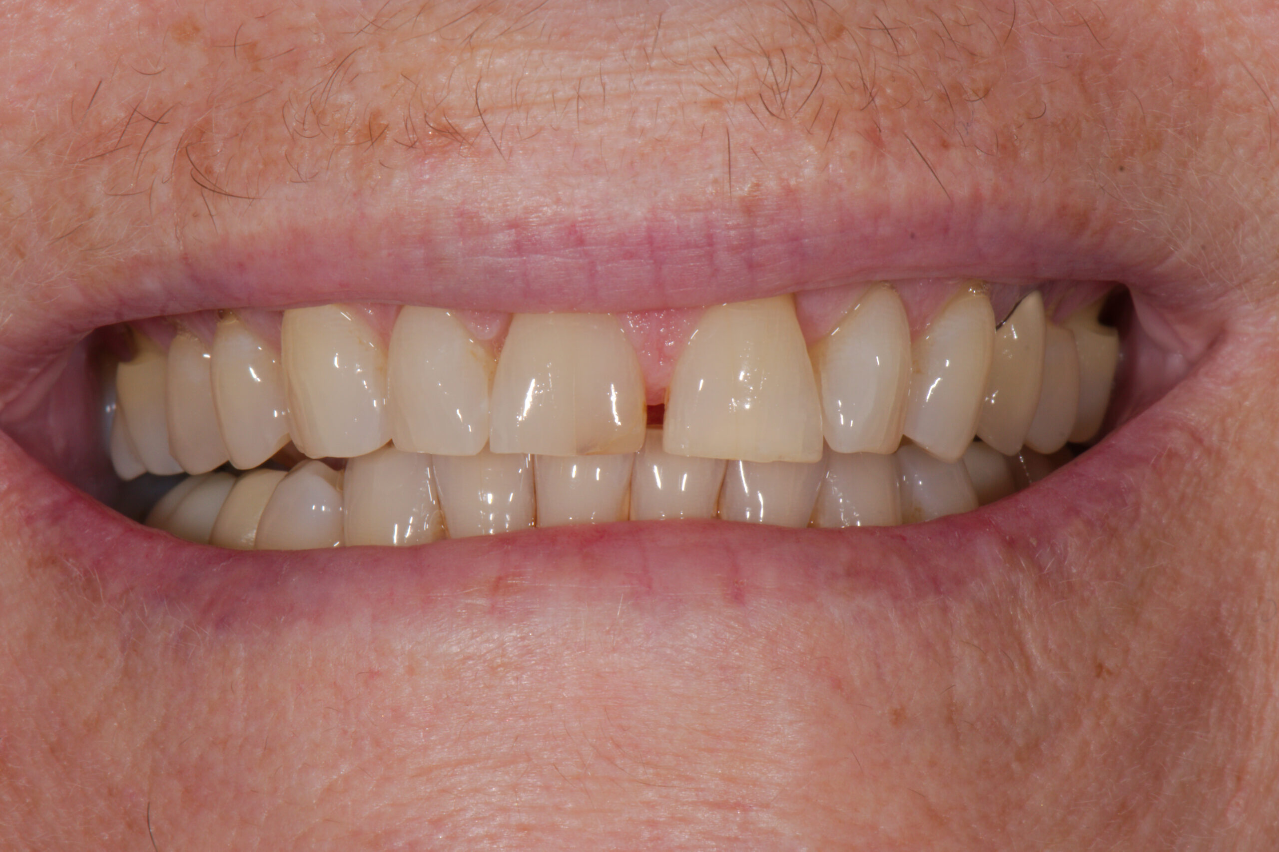 Invisalign 18 weeks and spot repair, Z Dentistry