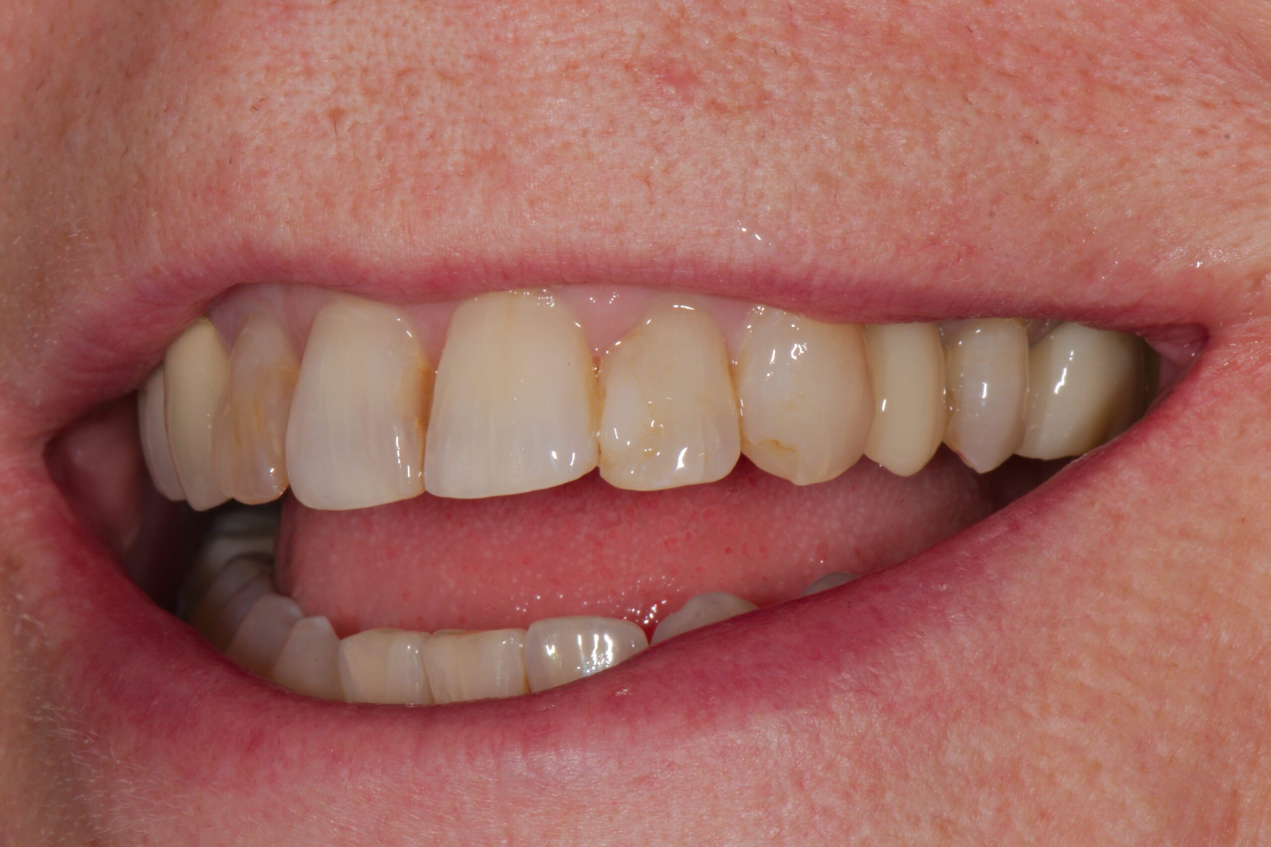 AFTER: Replace/Implant upper left tooth