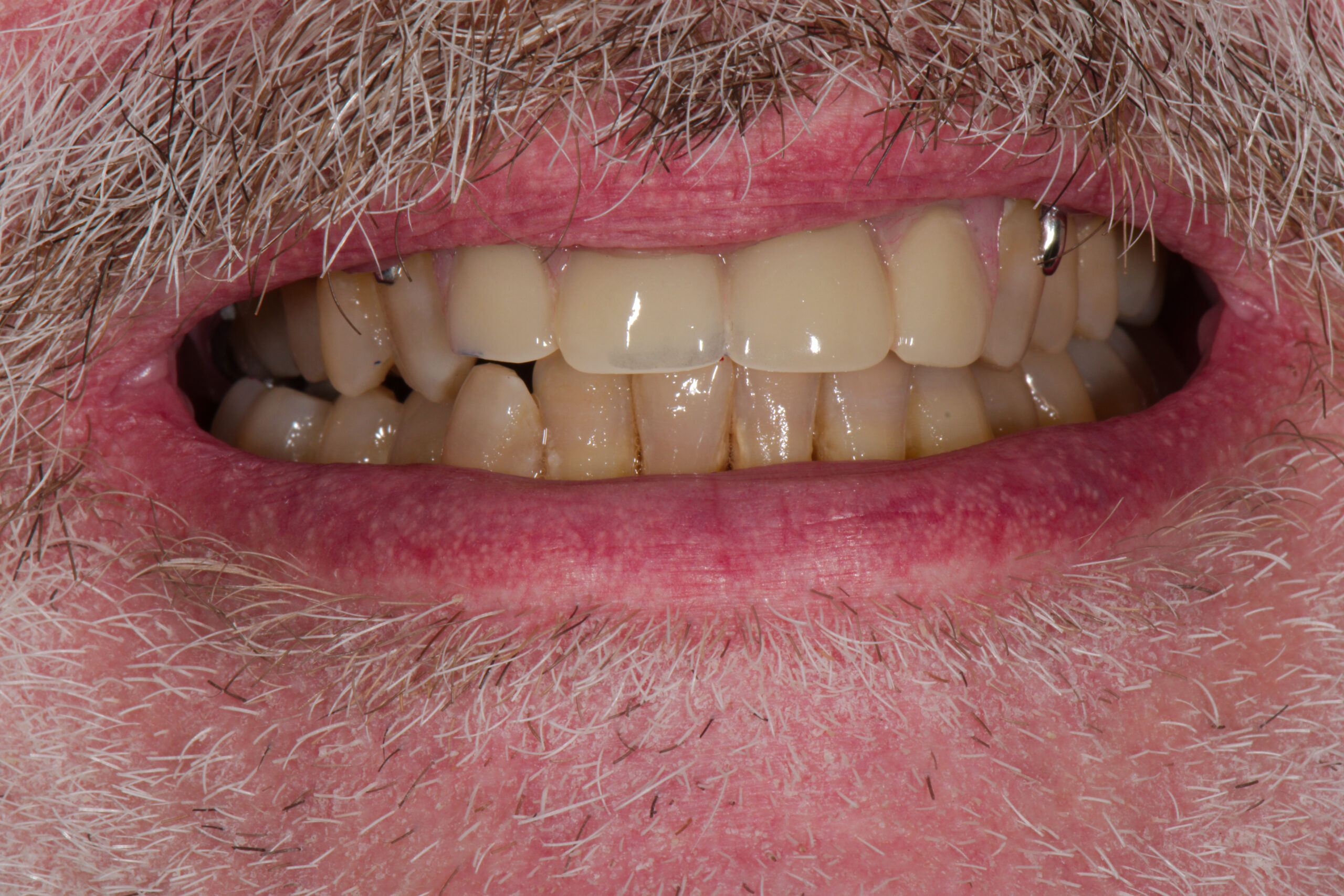 AFTER: Upper Front Partial Denture