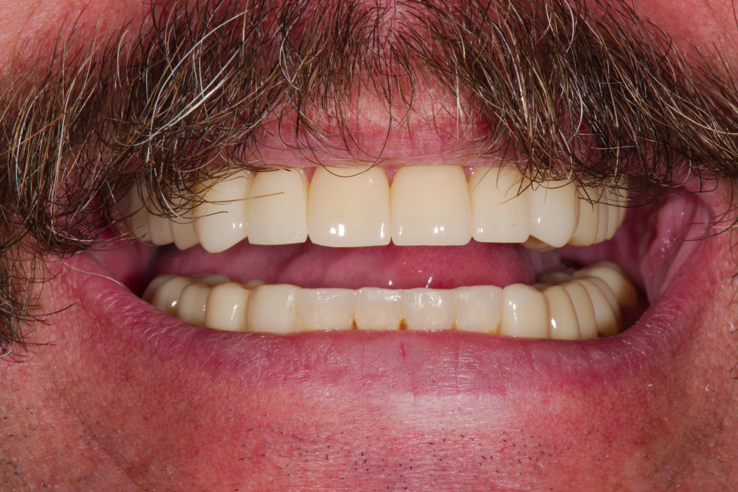 AFTER: Full Mouth Crowns to Fix Extreme Wear