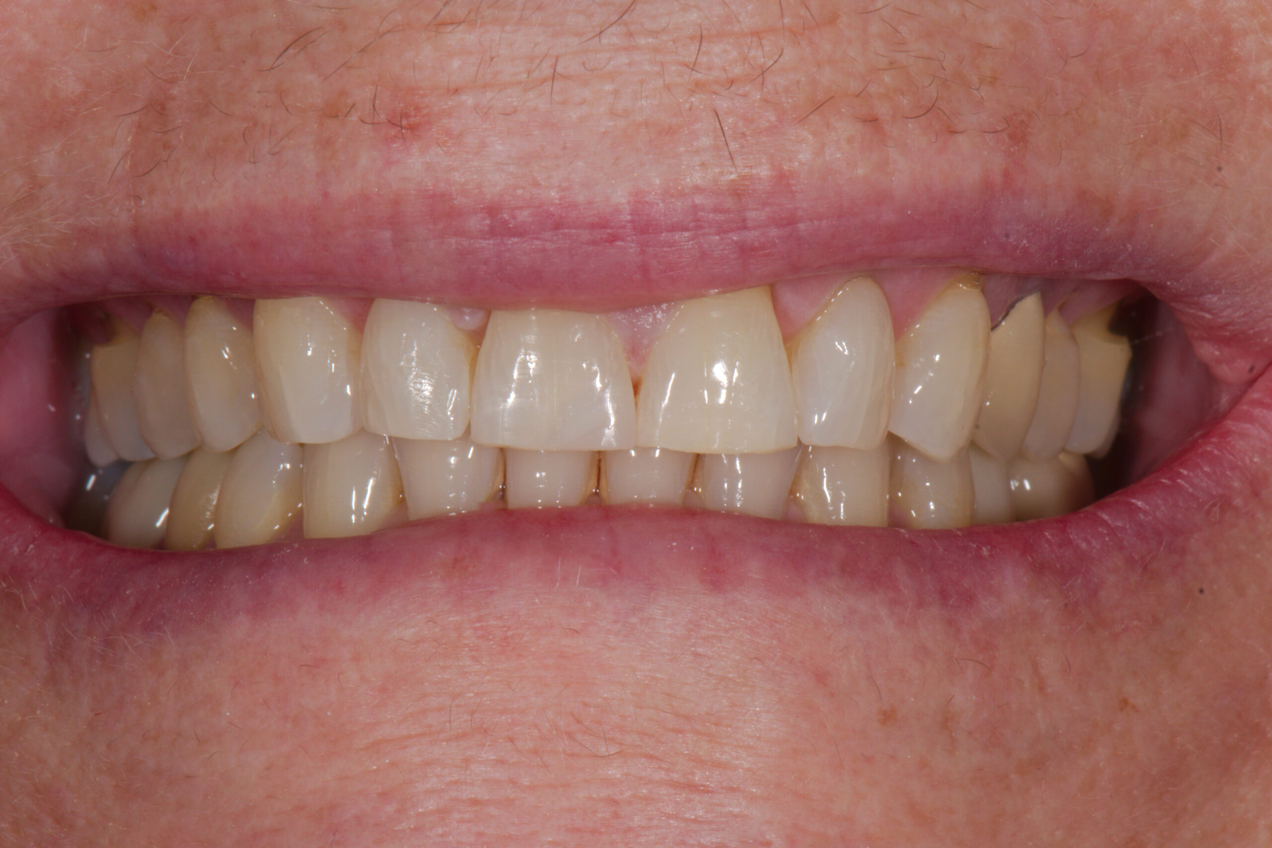AFTER: Invisalign 18 weeks and spot repair, Z Dentistry