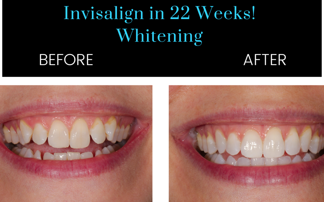 Transformed Smiles: Invisalign Before and After