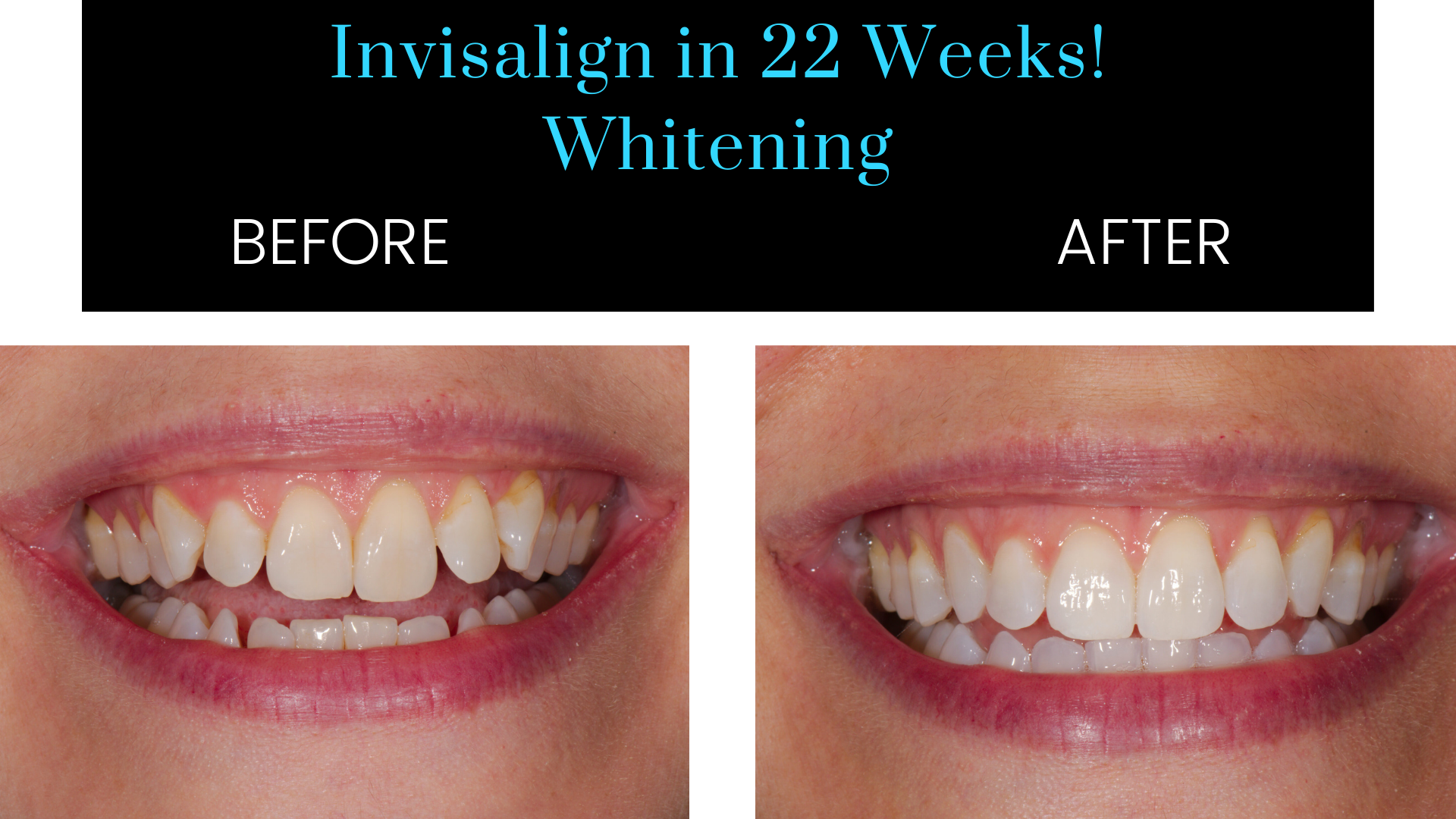 Invisalign before and after, Z Dentistry, Roanoke, TX