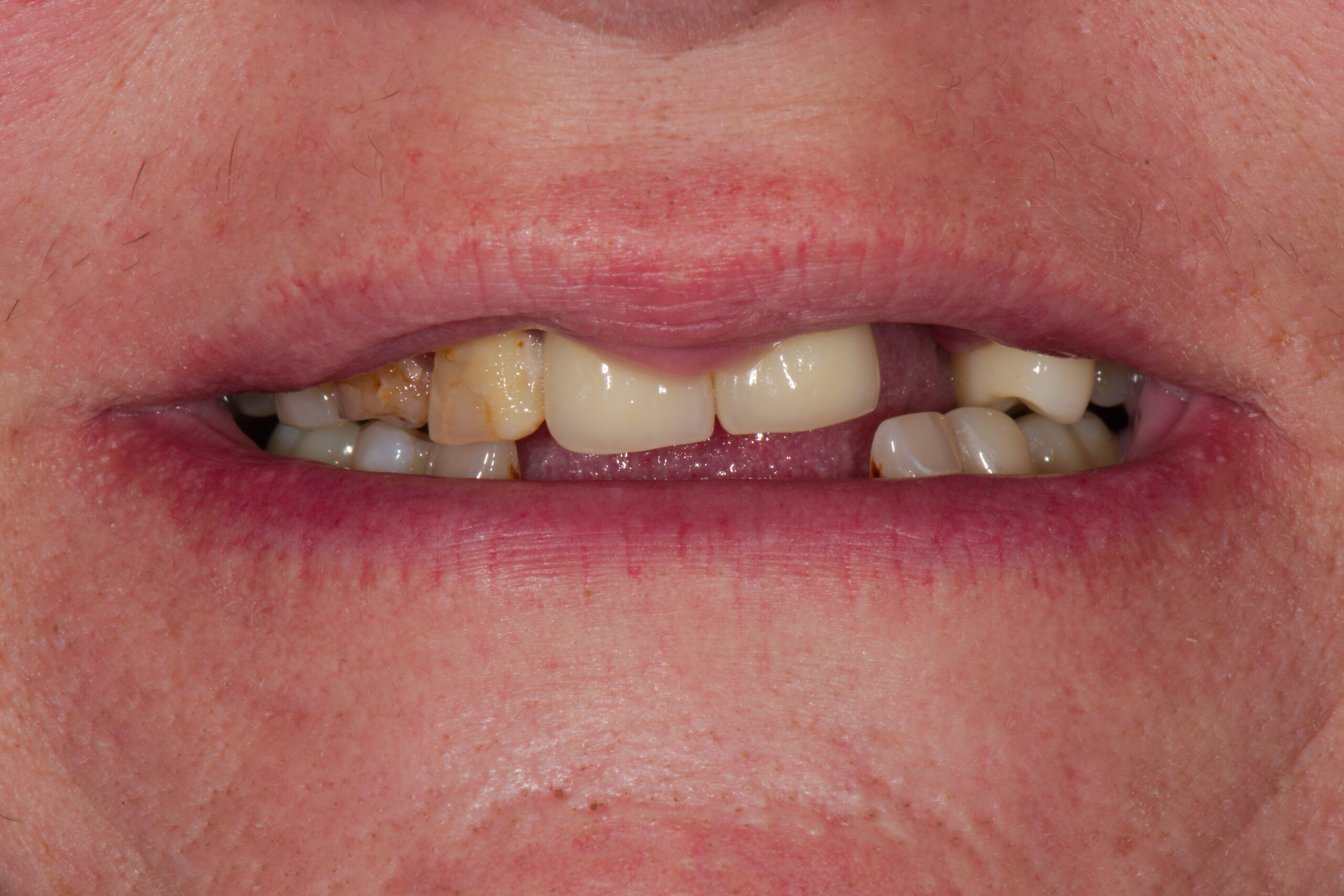 before: upper conventional denture, lower implant supported denture, Z Dentistry, Roanoke, TX