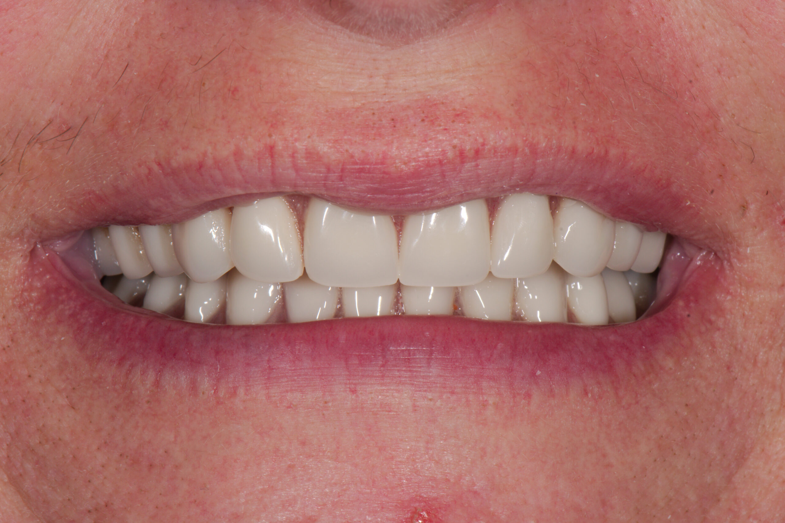 after: upper conventional denture, lower implant supported denture, Z Dentistry, Roanoke, TX