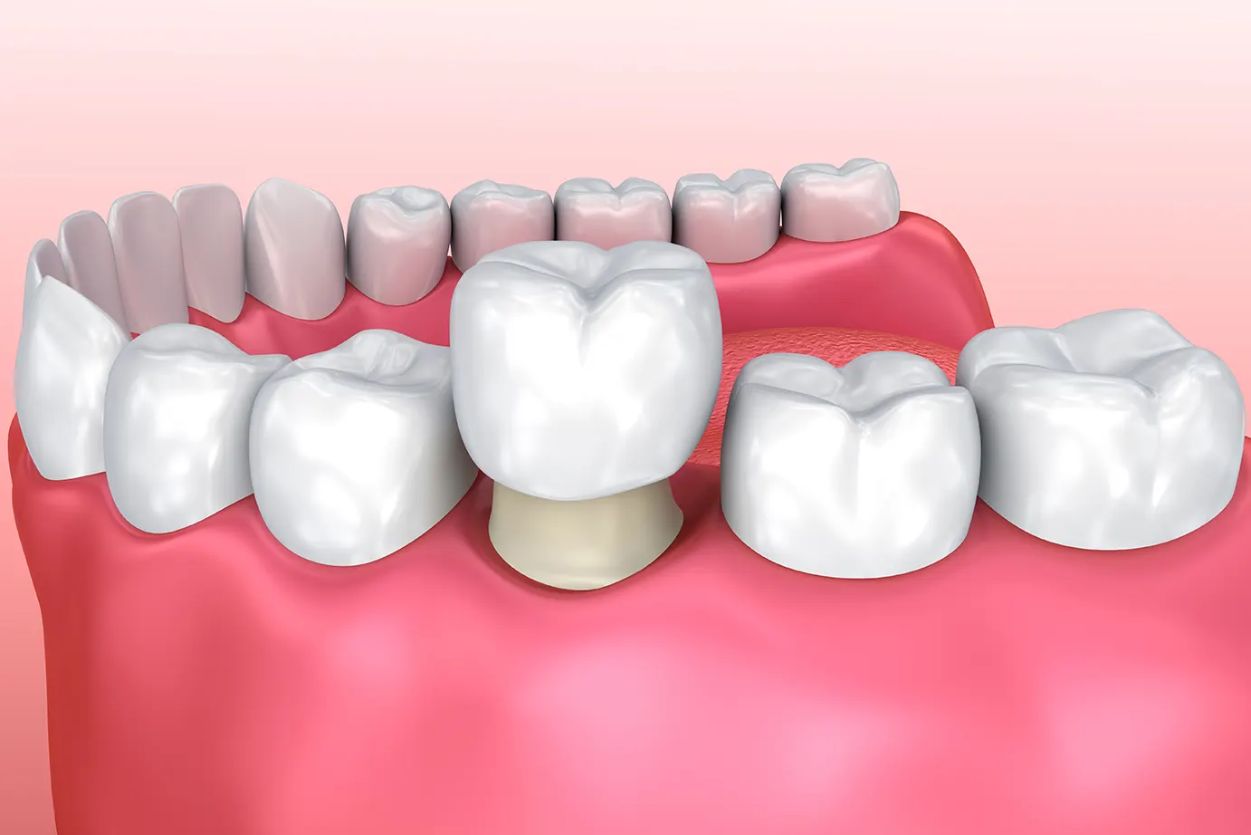 Dental Crowns veneers in Roanoke