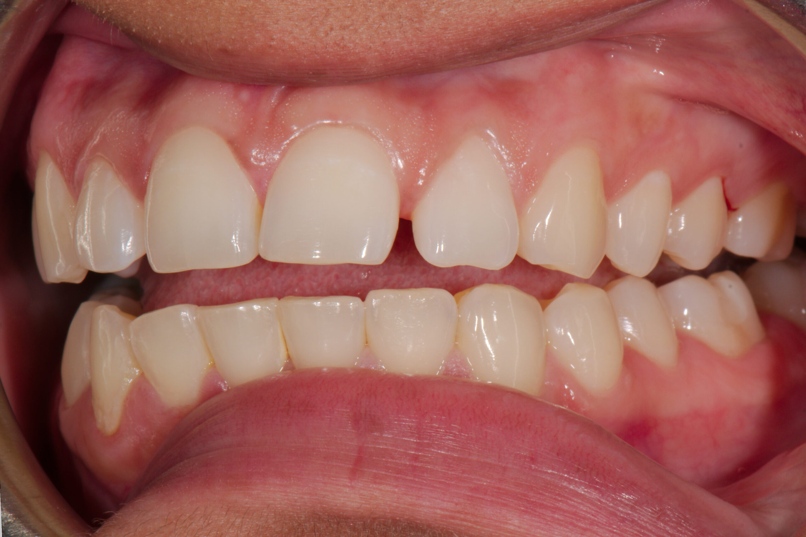 Before: 9.5 Weeks of Invisalign, Z Dentistry, Northlake, TX