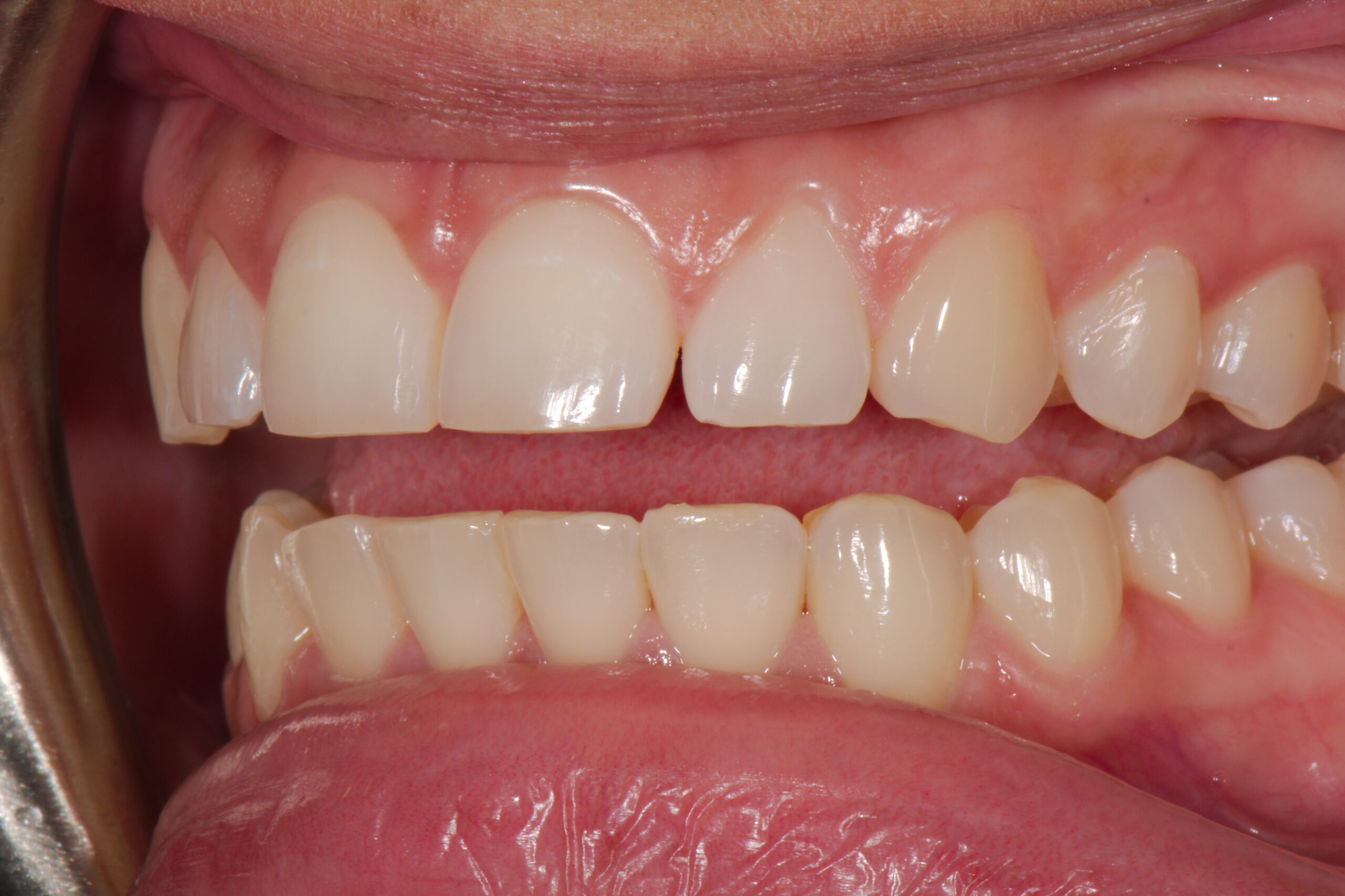After: 9.5 Weeks of Invisalign, Z Dentistry, Northlake, TX