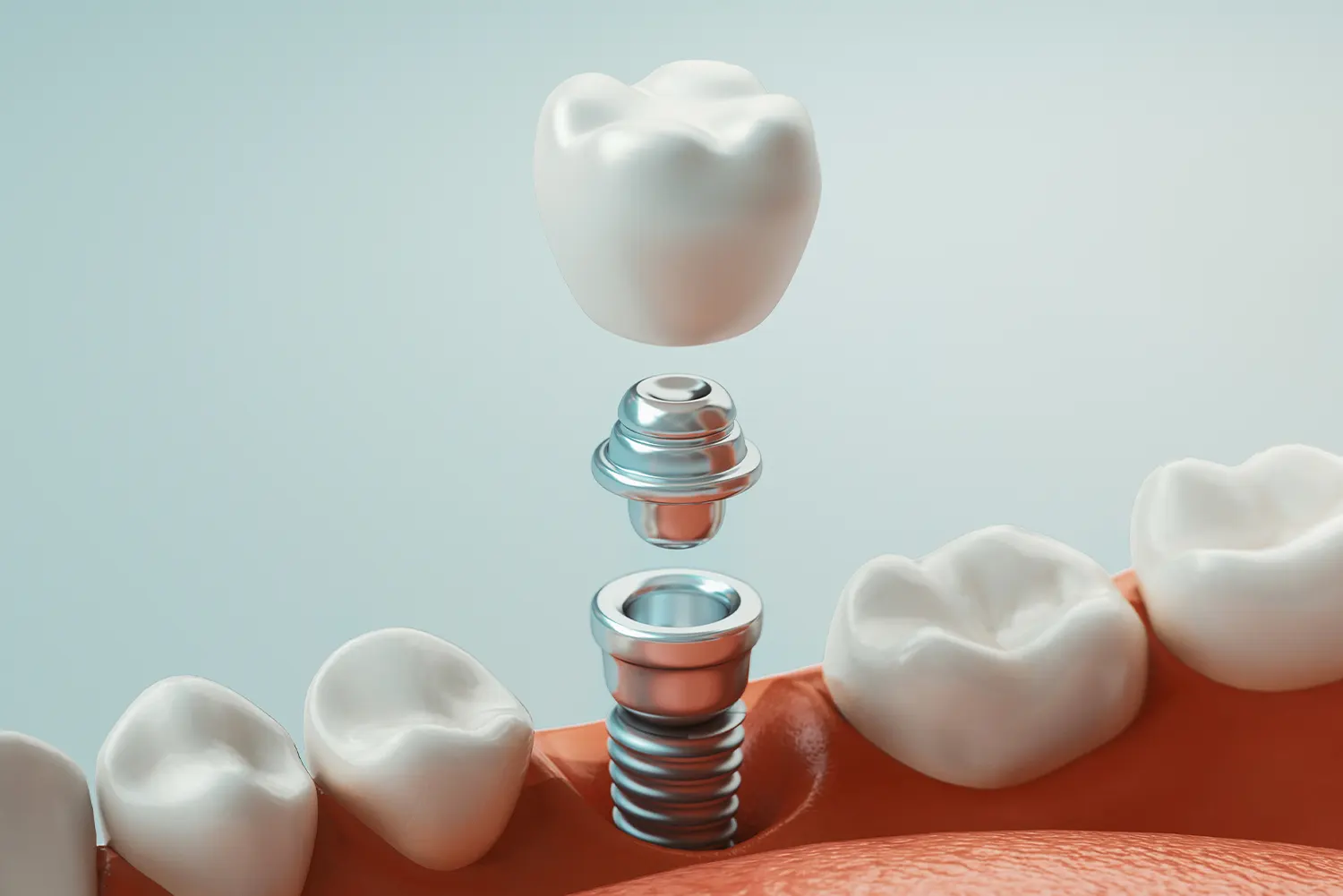 veneers in Roanoke 