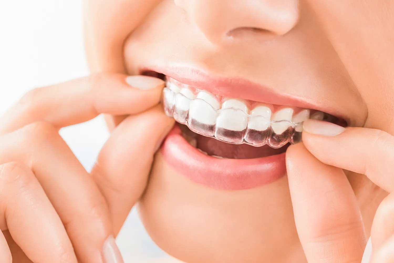 Invisalign veneers in Roanoke