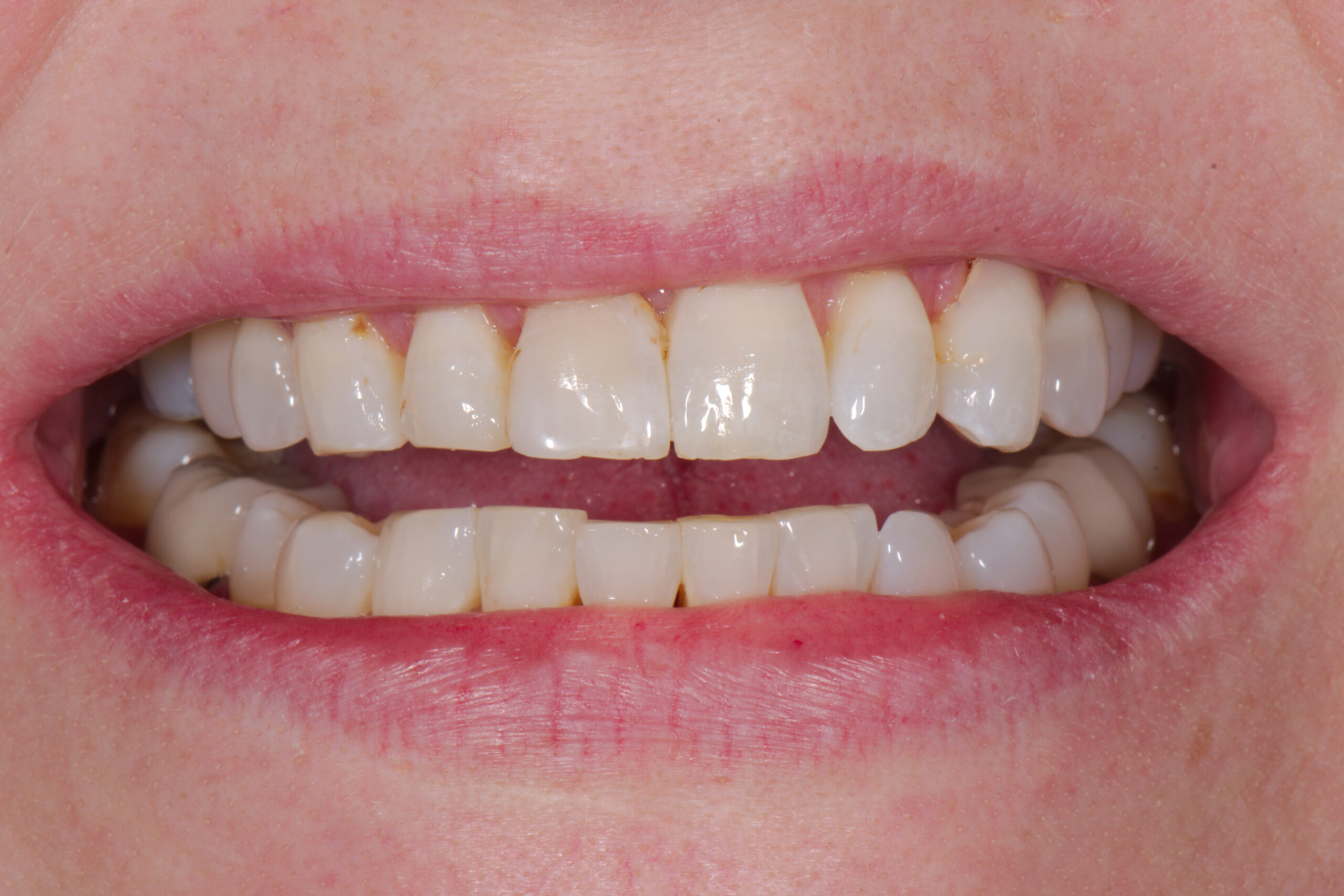 Chipped Teeth, Z Dentistry, Northlake, TX , Roanoke, TX